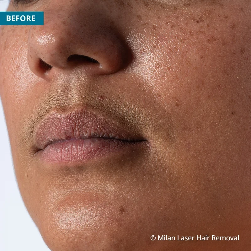 Face Before & After Photos of Laser Hair Removal | Milan Laser in  Washington, MD